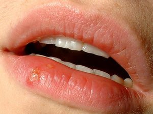 Cold Sores: What are they? What causes them?