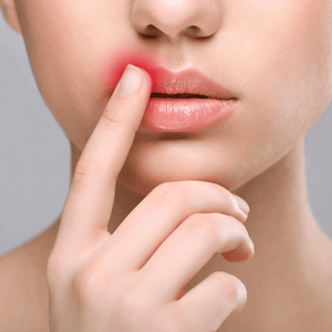 A woman squeezing her upper lip trying to pop a cold sore.